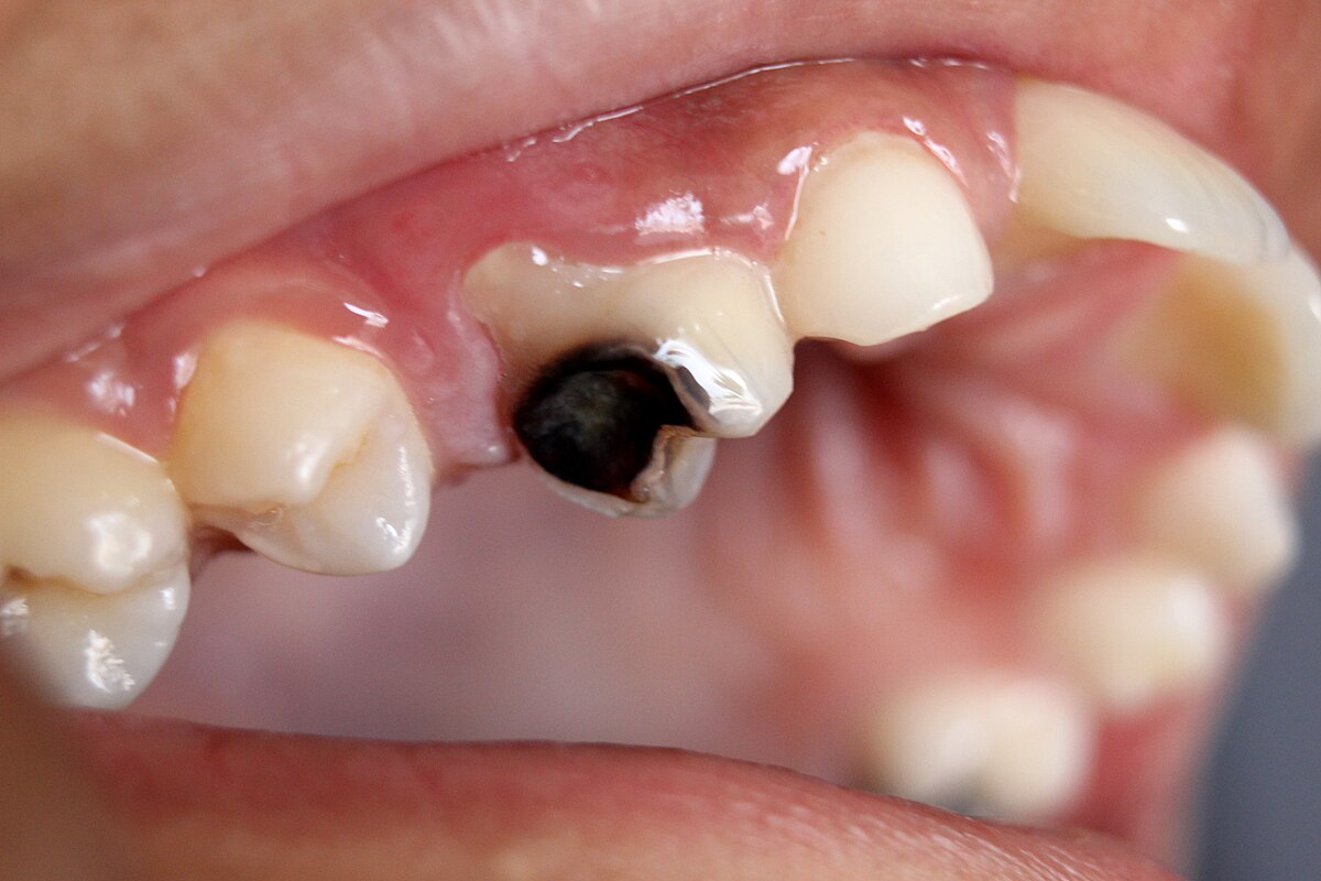  patient with common dental problems cavities