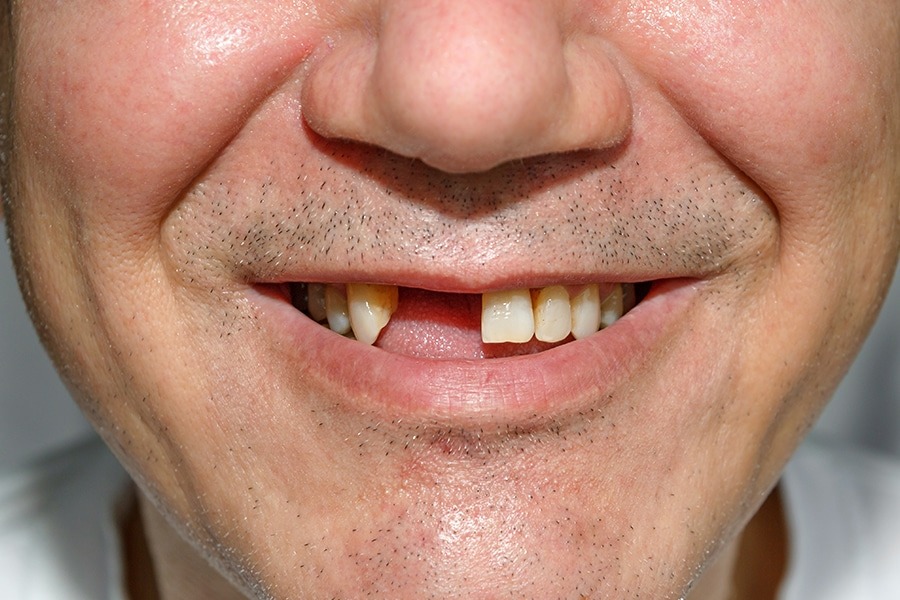 bigstock Smile Without Teeth With Brist 119428304