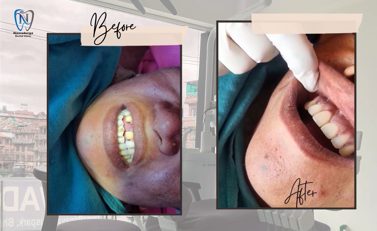 Before and after photo of patient with Dental Implant in Nawadurgadental clinic Bhaktapur