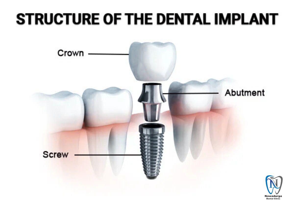 structure of dental implant